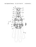 Pancarpal Arthrodesis Bone Plate diagram and image