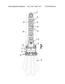 Pancarpal Arthrodesis Bone Plate diagram and image