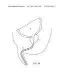 TISSUE RESECTION AND TREATMENT WITH SHEDDING PULSES diagram and image