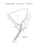 TISSUE RESECTION AND TREATMENT WITH SHEDDING PULSES diagram and image