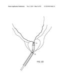 TISSUE RESECTION AND TREATMENT WITH SHEDDING PULSES diagram and image