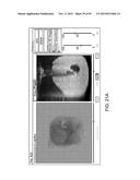 TISSUE RESECTION AND TREATMENT WITH SHEDDING PULSES diagram and image