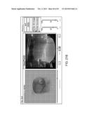 TISSUE RESECTION AND TREATMENT WITH SHEDDING PULSES diagram and image