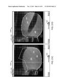 TISSUE RESECTION AND TREATMENT WITH SHEDDING PULSES diagram and image