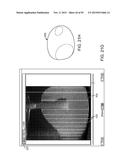 TISSUE RESECTION AND TREATMENT WITH SHEDDING PULSES diagram and image