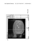 TISSUE RESECTION AND TREATMENT WITH SHEDDING PULSES diagram and image