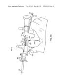 TISSUE RESECTION AND TREATMENT WITH SHEDDING PULSES diagram and image