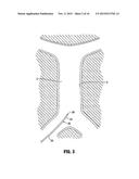 METHOD OF INSERTING A VEIN FILTER diagram and image