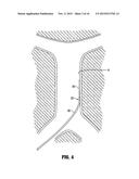 METHOD OF INSERTING A VEIN FILTER diagram and image