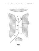 METHOD OF INSERTING A VEIN FILTER diagram and image