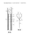 METHOD OF INSERTING A VEIN FILTER diagram and image