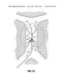 METHOD OF INSERTING A VEIN FILTER diagram and image