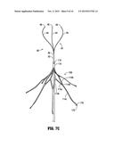 METHOD OF INSERTING A VEIN FILTER diagram and image