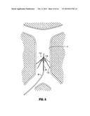 METHOD OF INSERTING A VEIN FILTER diagram and image