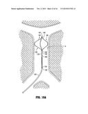 METHOD OF INSERTING A VEIN FILTER diagram and image