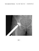 ACETABULAR COMPONENT ANTEVERSION AND ABDUCTION MEASUREMENT SYSTEM AND     METHOD diagram and image