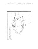 FEMTO SECOND MULTI SHOOTING FOR EYE SURGERY diagram and image