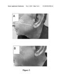 COMPOSITIONS OF ALUMINUM FLUORIDE AND METHODS OF USE THEREOF FOR THE     TREATMENT AND PREVENTION OF ACTINIC KERATOSIS AND SUN-INDUCED DAMAGES diagram and image