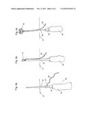 FIBROIN-CONTAINING HYDROGELS FOR PELVIC TISSUE TREATMENT diagram and image