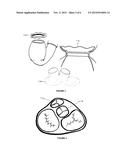 PERMANENT TOTAL ARTIFICIAL HEART DEVICE diagram and image