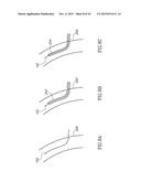 VARIABLE LENGTH CATHETER FOR TREATING A VESSEL CONTAINING THROMBUS diagram and image