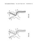 VARIABLE LENGTH CATHETER FOR TREATING A VESSEL CONTAINING THROMBUS diagram and image