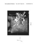 TRACKING DURING RADIATION TREATMENT USING ULTRASOUND IMAGING diagram and image