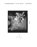 TUMOR TRACKING DURING RADIATION TREATMENT USING ULTRASOUND IMAGING diagram and image