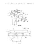 Patient-Specific Elbow Guides And Associated Methods diagram and image