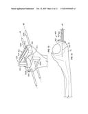 Patient-Specific Elbow Guides And Associated Methods diagram and image