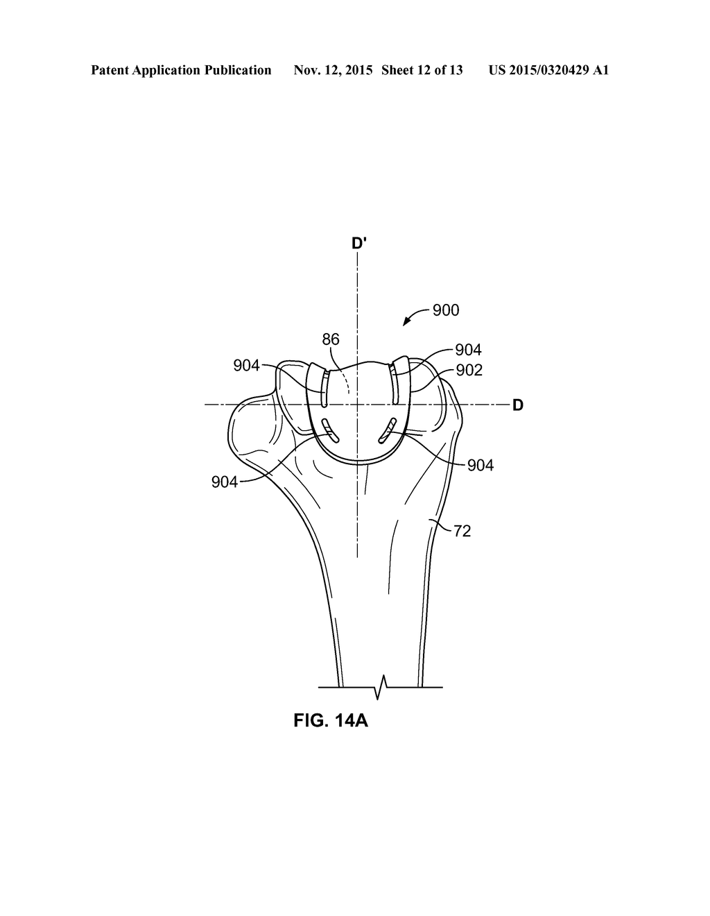 Patient-Specific Elbow Guides And Associated Methods - diagram, schematic, and image 13