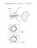 COMPUTER AIDED IMAGE-BASED ENHANCED INTRACORPOREAL LITHOTRIPSY diagram and image