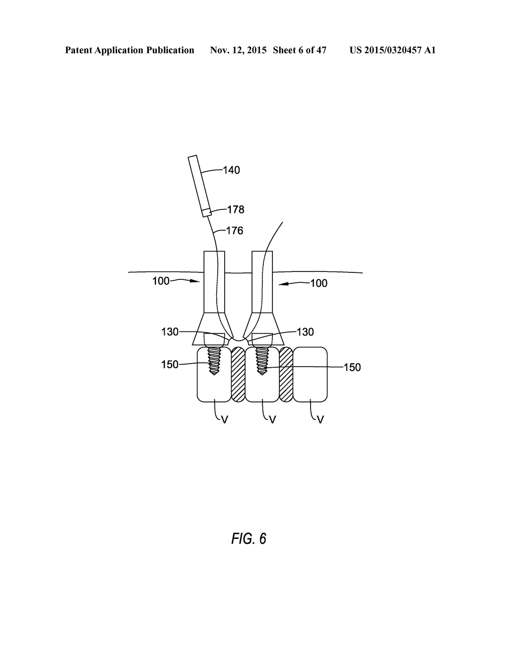 METHODS AND APPARATUS FOR ACCESS TO AND/OR TREATMENT OF THE SPINE - diagram, schematic, and image 07