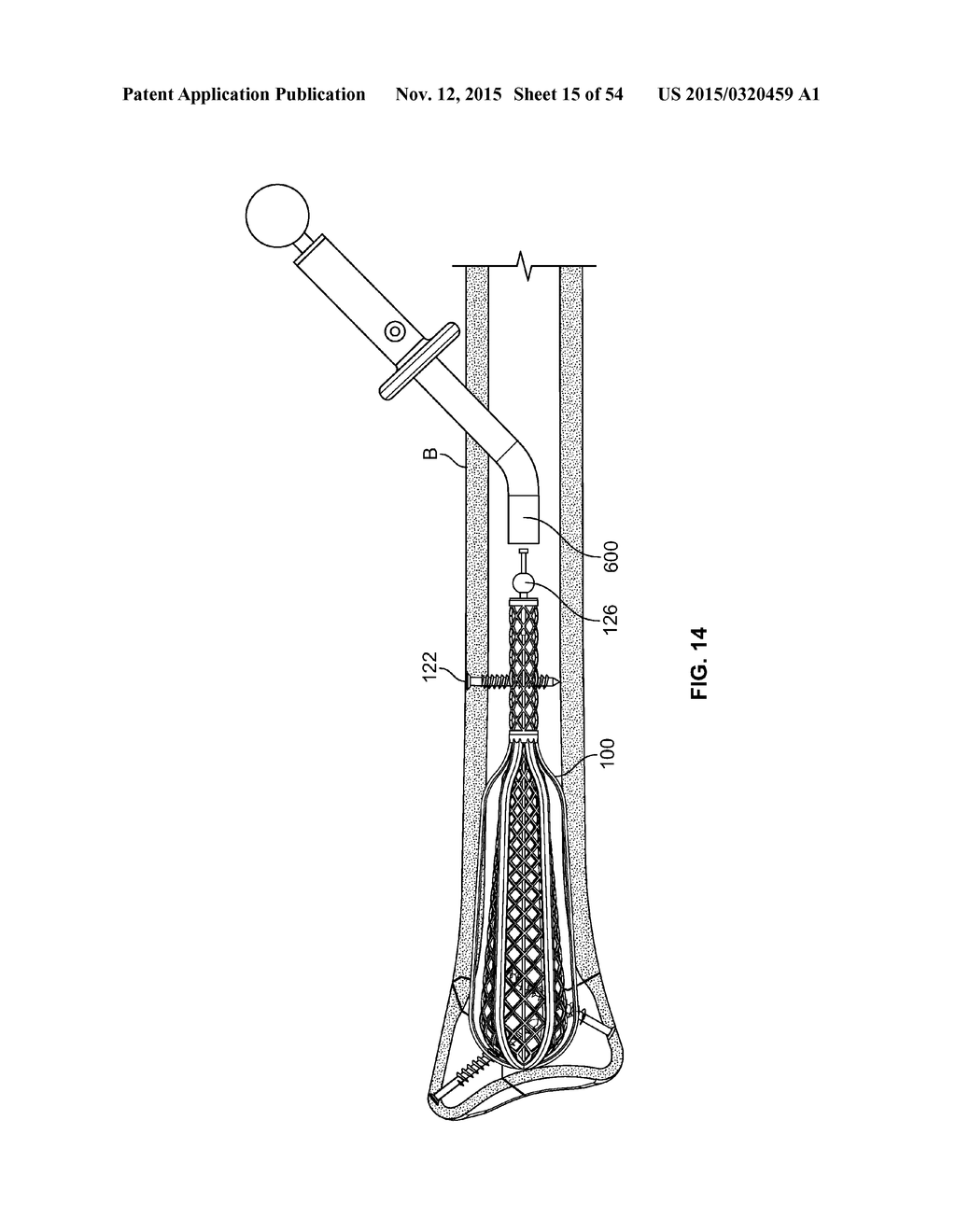 APPARATUS AND METHODS FOR FRACTURE REPAIR - diagram, schematic, and image 16