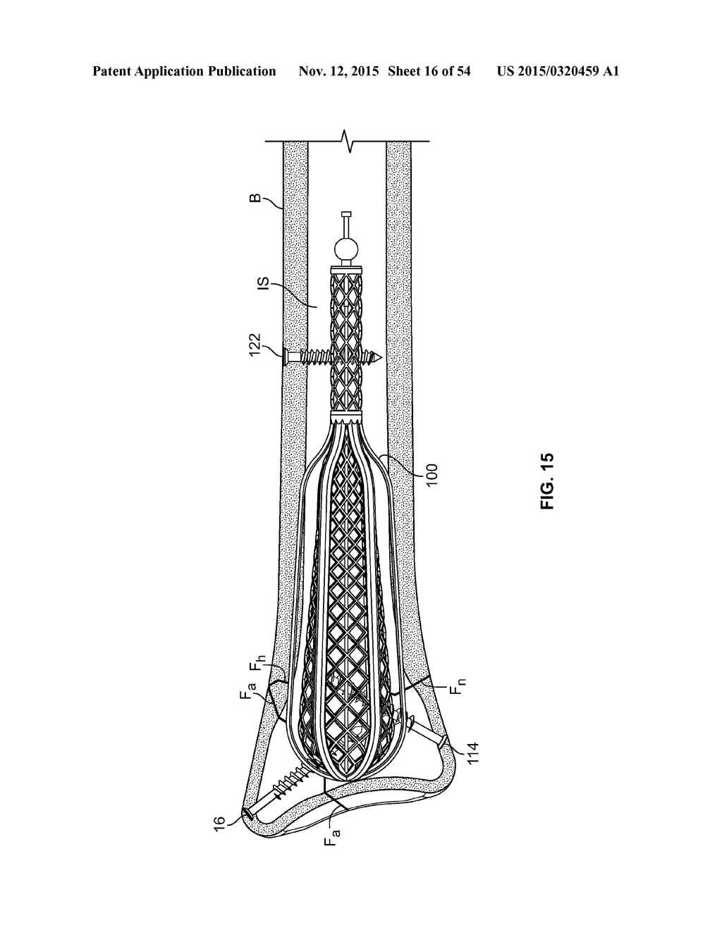 APPARATUS AND METHODS FOR FRACTURE REPAIR - diagram, schematic, and image 17