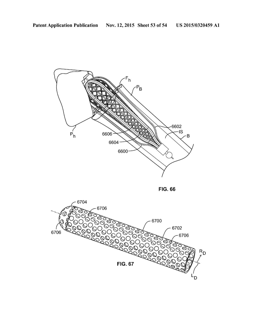 APPARATUS AND METHODS FOR FRACTURE REPAIR - diagram, schematic, and image 54