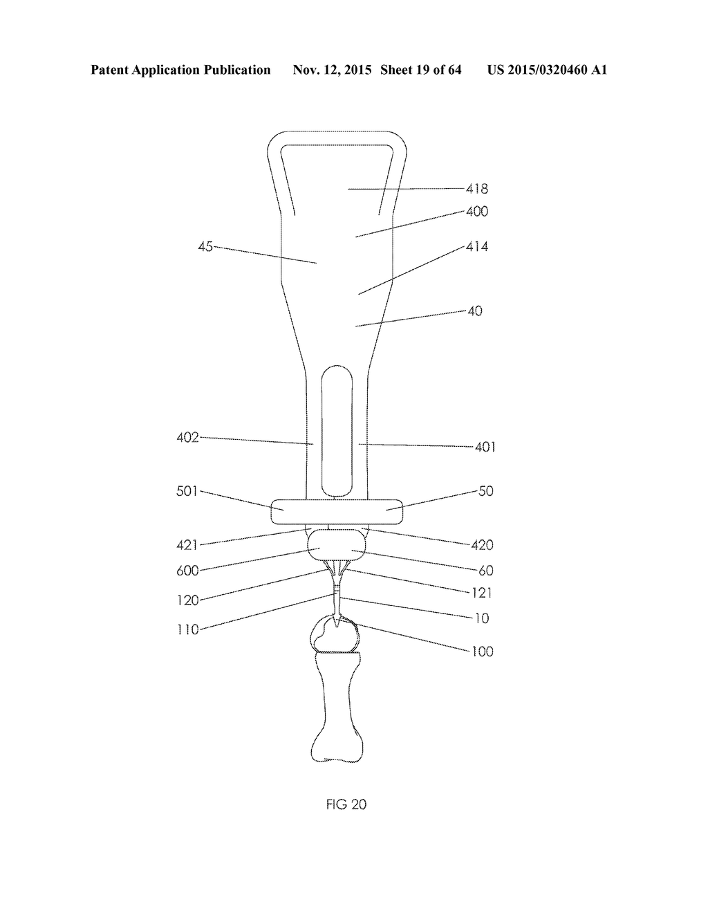 METHOD AND APPARATUS FOR AN INTRAMUDULLARY IMPLANT AND METHOD OF     IMPLANTATION THEREOF - diagram, schematic, and image 20