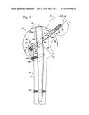 HIP FIXATION WITH LOAD-CONTROLLED DYNAMIZATION diagram and image