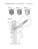 HIP FIXATION WITH LOAD-CONTROLLED DYNAMIZATION diagram and image