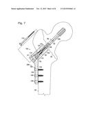 HIP FIXATION WITH LOAD-CONTROLLED DYNAMIZATION diagram and image