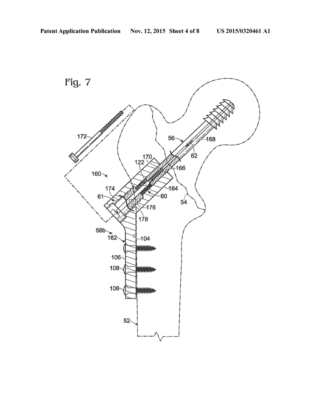 HIP FIXATION WITH LOAD-CONTROLLED DYNAMIZATION - diagram, schematic, and image 05