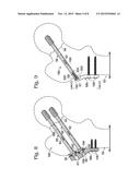 HIP FIXATION WITH LOAD-CONTROLLED DYNAMIZATION diagram and image