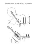 HIP FIXATION WITH LOAD-CONTROLLED DYNAMIZATION diagram and image