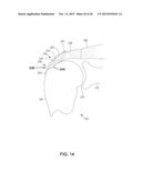 MEDICAL IMPLANT DELIVERY SYSTEM AND RELATED METHODS diagram and image