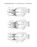 COLLAPSIBLE PROSTHETIC VALVE diagram and image