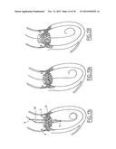 COLLAPSIBLE PROSTHETIC VALVE diagram and image