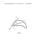 TOROIDAL BALLOON FOR EXTERNAL OR INTERNAL COMPRESSION WITH UNIQUE     INSERTION OR REMOVAL diagram and image