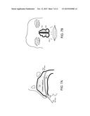 TOROIDAL BALLOON FOR EXTERNAL OR INTERNAL COMPRESSION WITH UNIQUE     INSERTION OR REMOVAL diagram and image