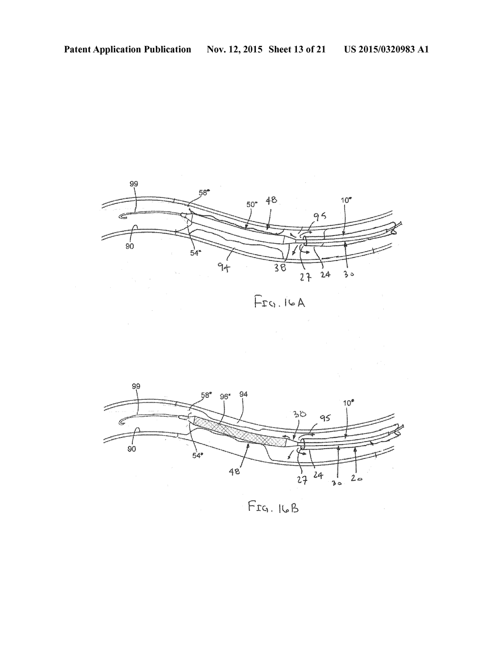 APPARATUS AND METHODS FOR TREATING OBSTRUCTIONS WITHIN BODY LUMENS - diagram, schematic, and image 14