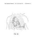 TRIGGERED PACING SYSTEM diagram and image